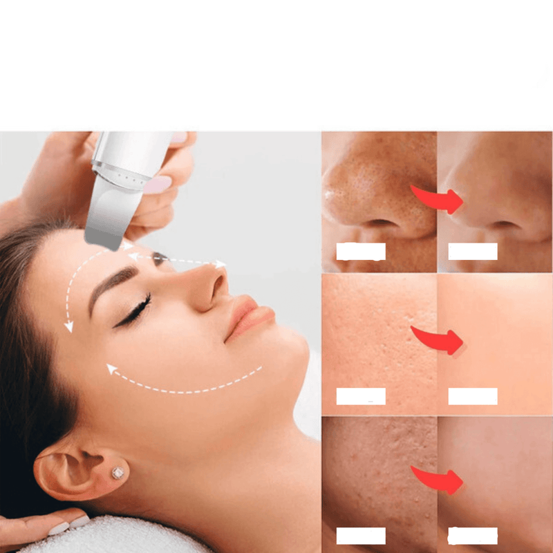 AcheinaWeb Esfoliador Ultrassônico de Pele: Removedor de Cravos e Limpador Facial com Cavitação